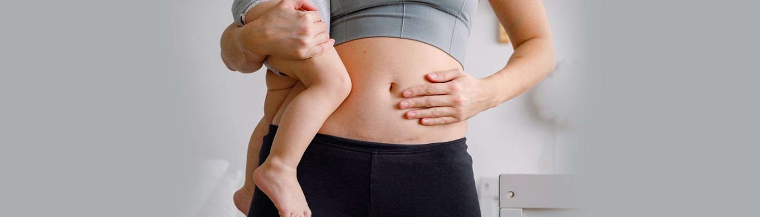 5 Hacks to help get your body back after a C-section